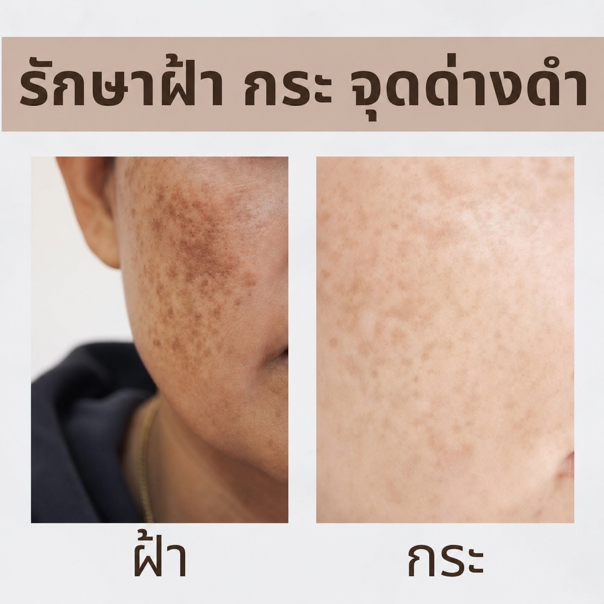 قبل وبعد التقشير الكيميائي في ProDerma – تقليل التصبغات ووضوح البشرة