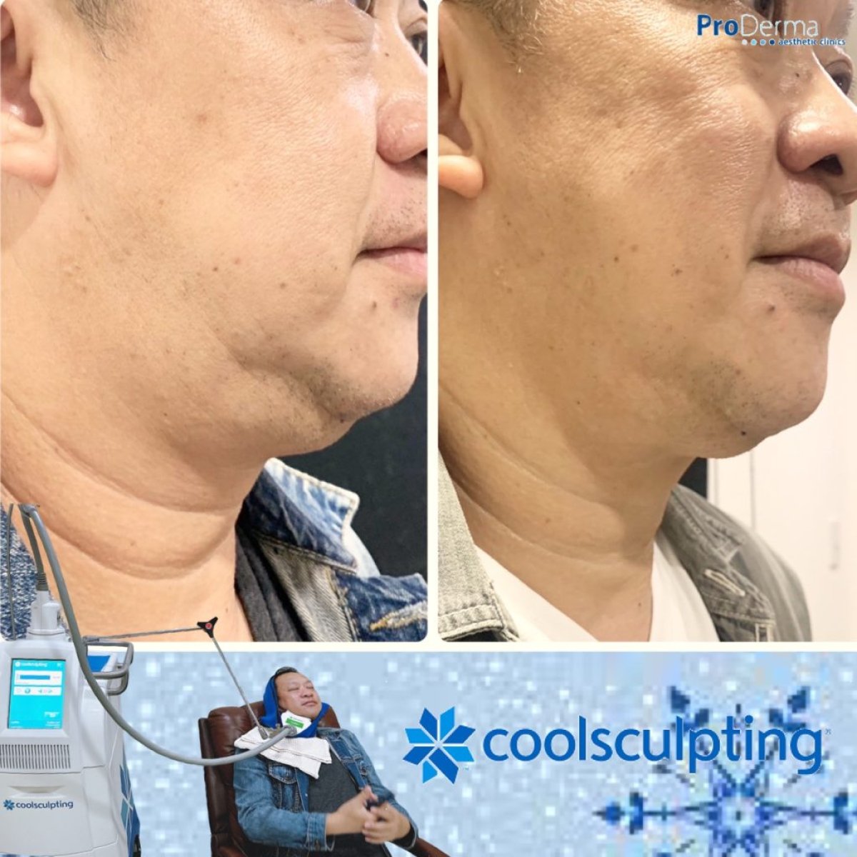 Résultats avant/après réduction du double menton par Coolsculpting chez ProDerma