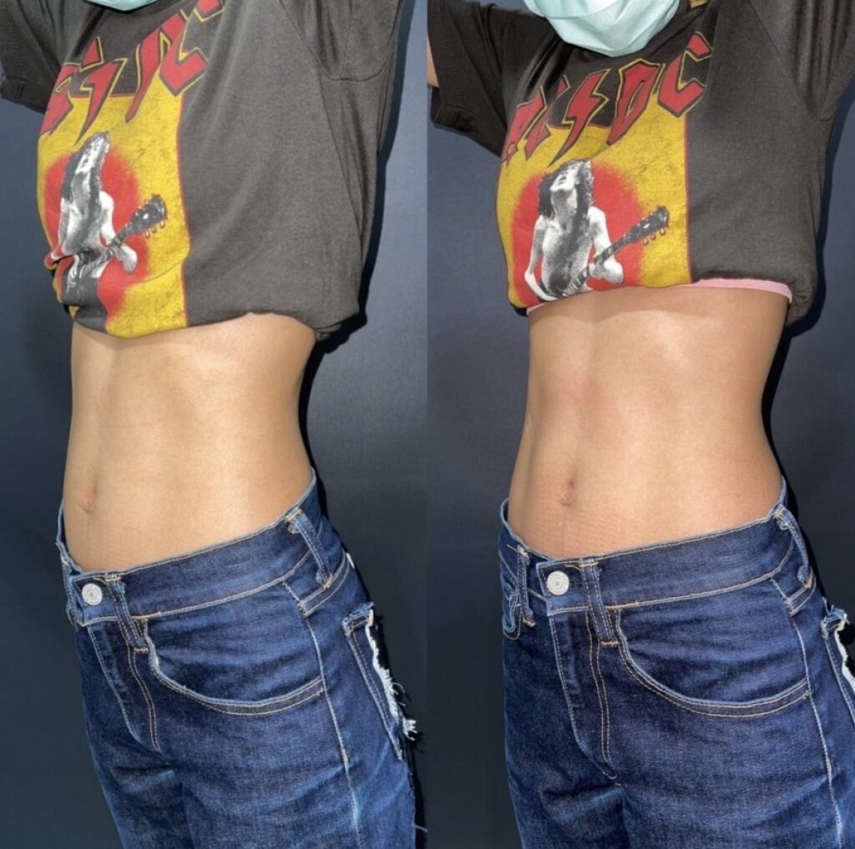Avant et après cryolipolyse chez ProDerma – réduction visible de la graisse abdominale