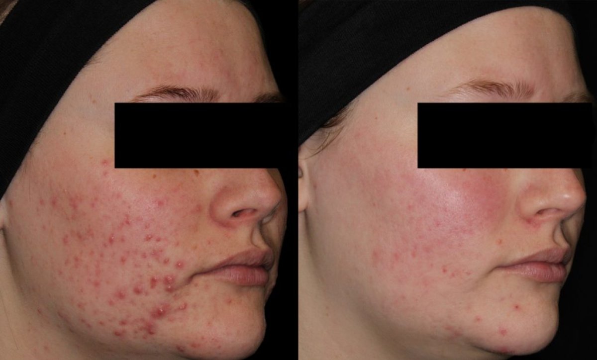 Before and after acne scar treatment results at ProDerma – clearer, smoother facial skin