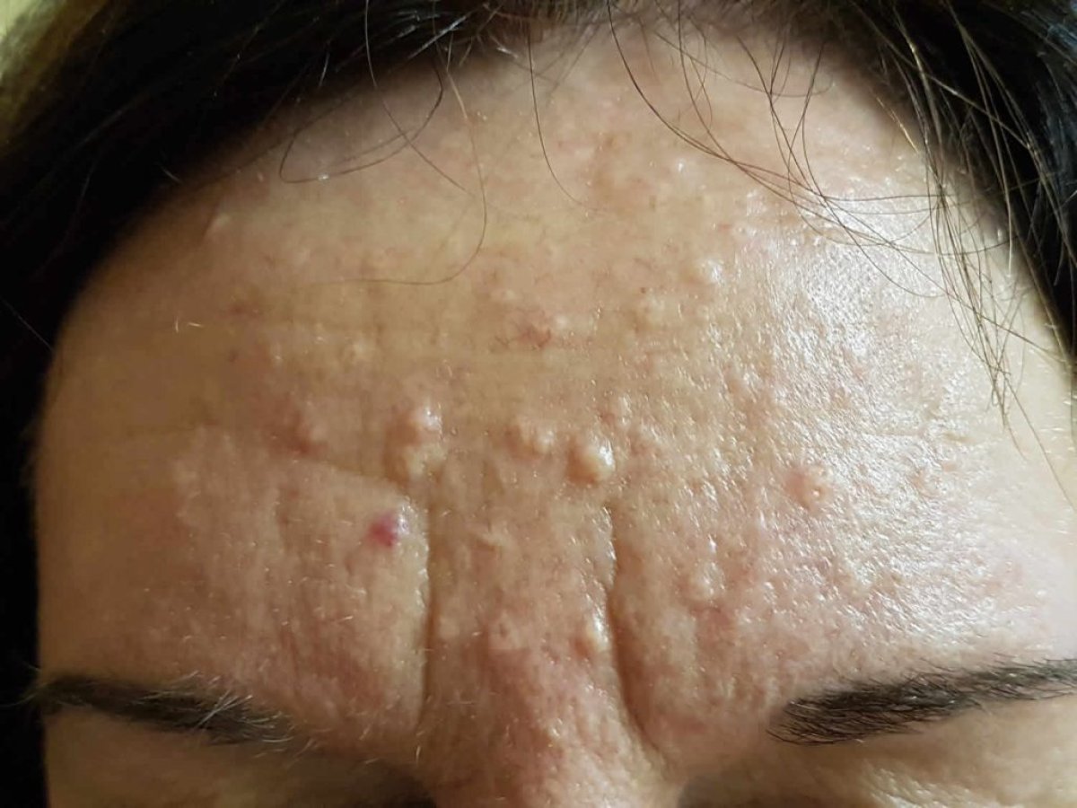 الجبهة قبل علاج ندبات حب الشباب في ProDerma، آثار وندبات واضحة على الجلد