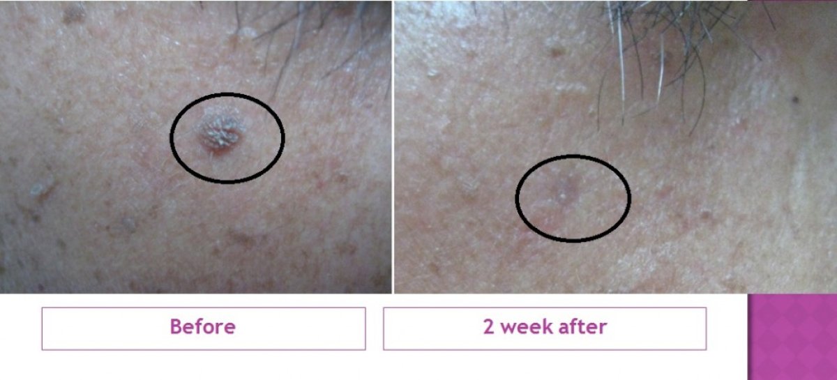 نتائج علاج ندبات حب الشباب قبل وبعد في ProDerma، تحسن ملمس البشرة خلال أسبوعين