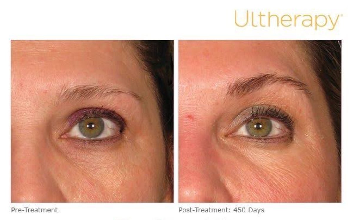 Ultherapy eye area rejuvenation before and after results at ProDerma – reduced wrinkles