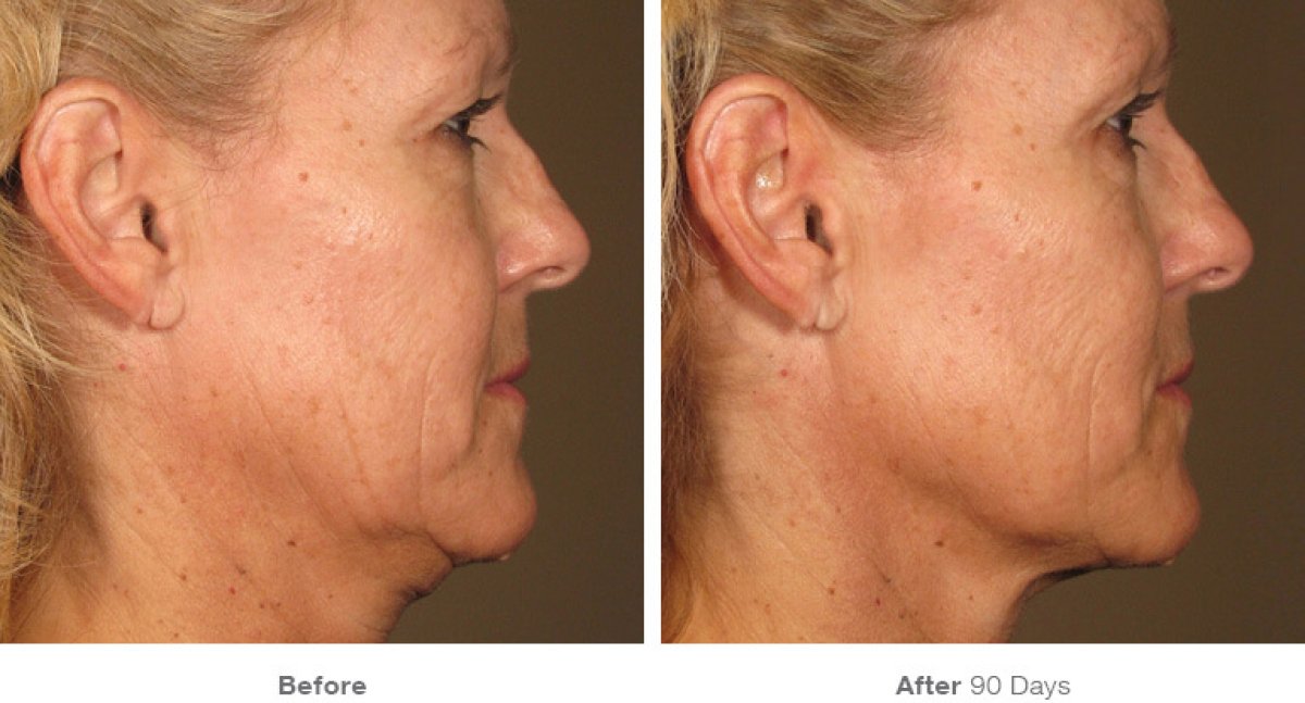 Before and after nonsurgical facelift at ProDerma, visible facial skin tightening result