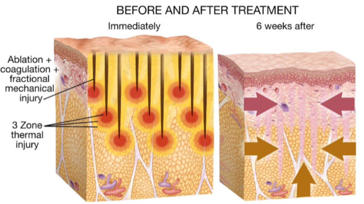 نتائج علاج ليزر CO2 في ProDerma – تجديد البشرة بعد 6 أسابيع