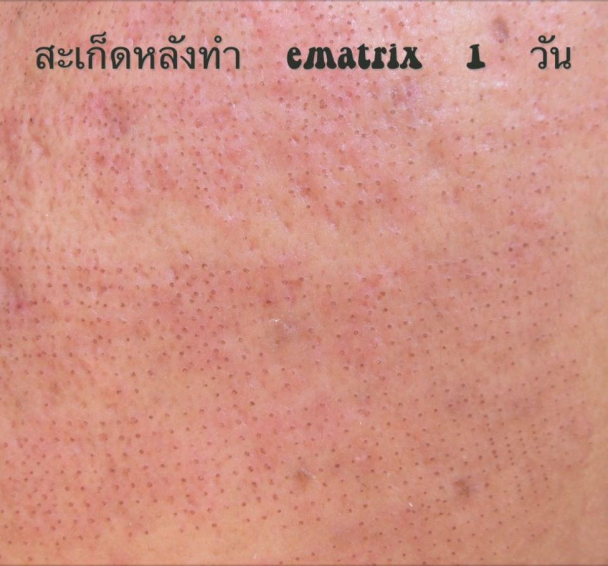 CO2 laser treatment result at ProDerma, visible skin texture improvement after procedure