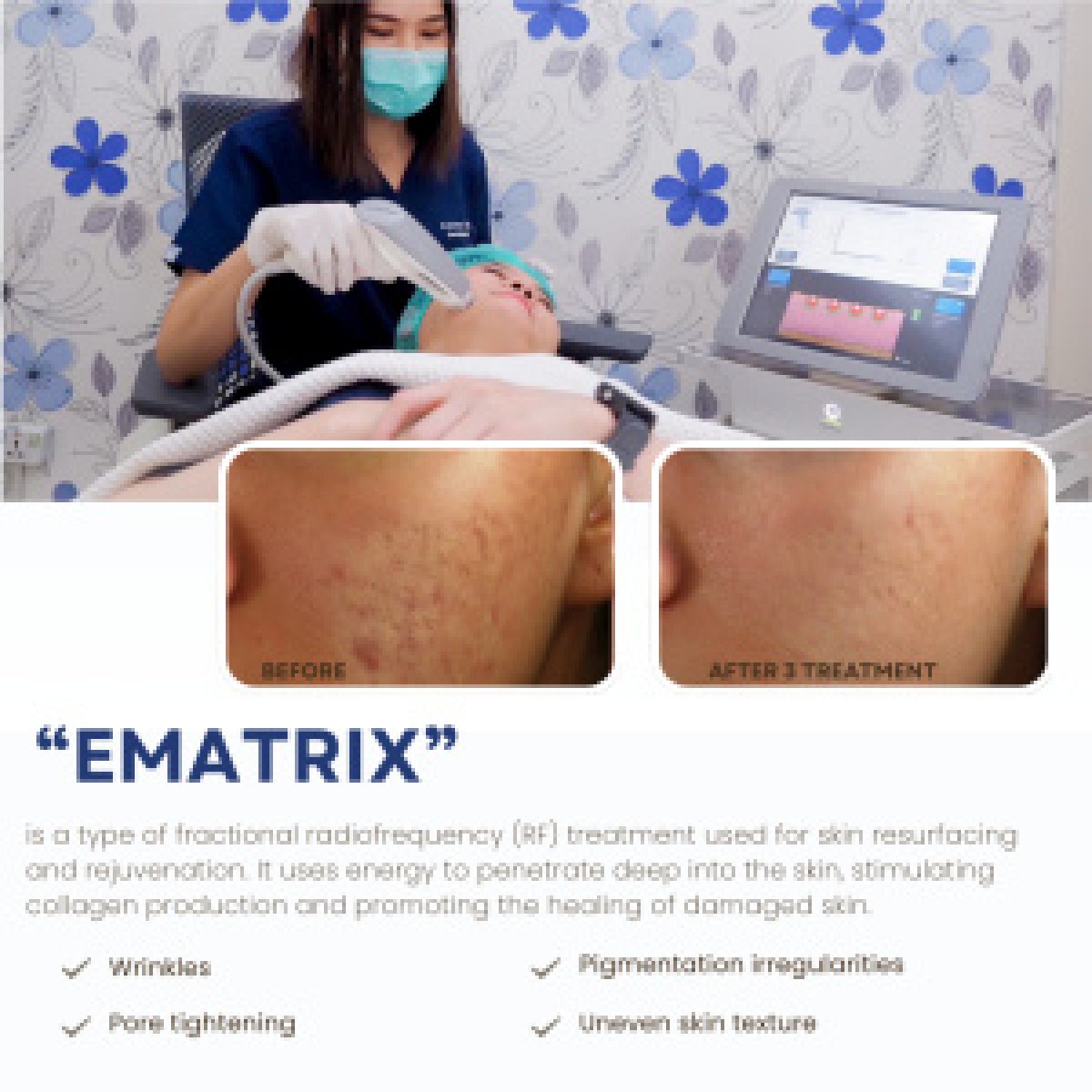 Before and after CO2 laser treatment at ProDerma, improved acne scars and smoother skin result
