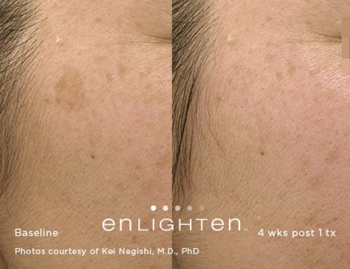 Resultados del tratamiento láser VBeam en ProDerma: reducción de pigmentación facial tras 4 semanas
