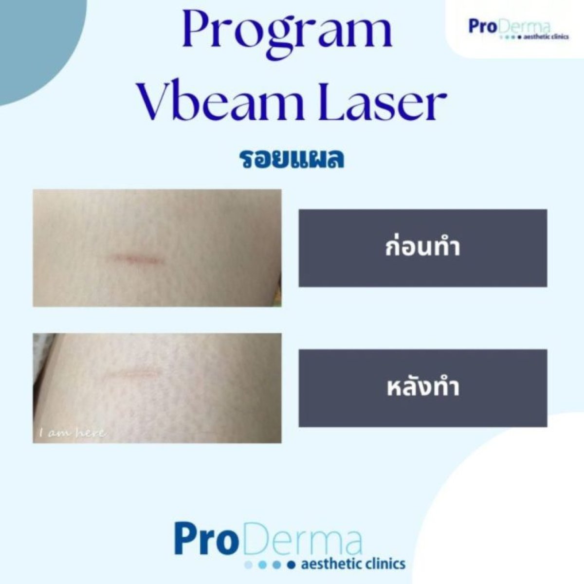 Resultados antes y después del tratamiento de cicatrices con láser VBeam en ProDerma