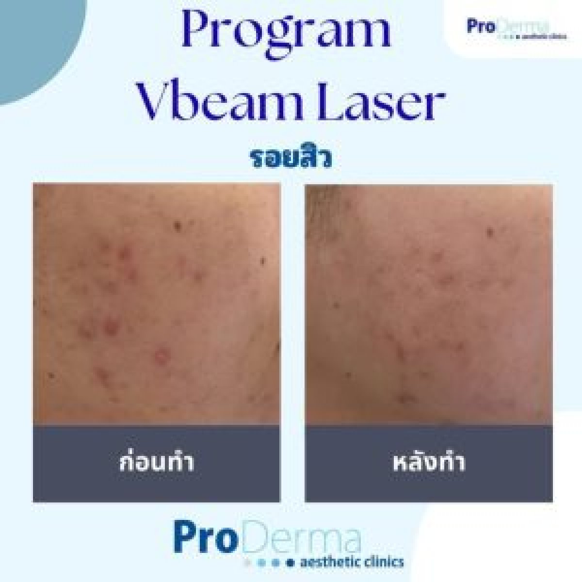 نتائج علاج ندبات حب الشباب بجهاز VBeam ليزر في ProDerma، تحسن ملحوظ للبشرة
