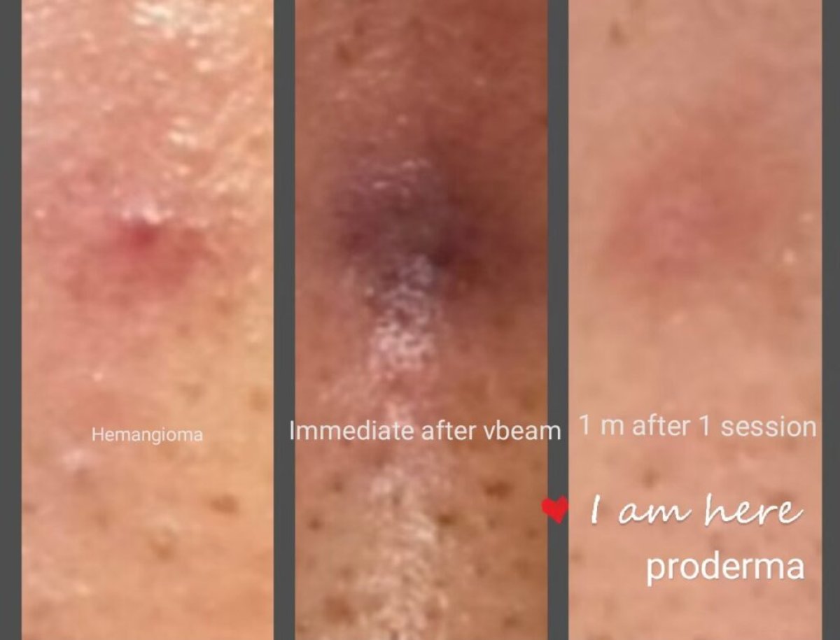 علاج الورم الوعائي بجهاز VBeam في ProDerma – قبل، بعد، ونتيجة بعد شهر