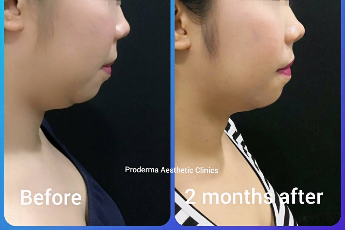 Before and after jawline contouring at ProDerma – improved chin and jaw definition result