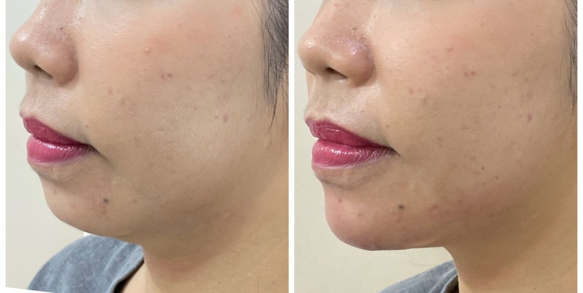Before and after jawline contouring at ProDerma, enhanced chin and jaw definition result