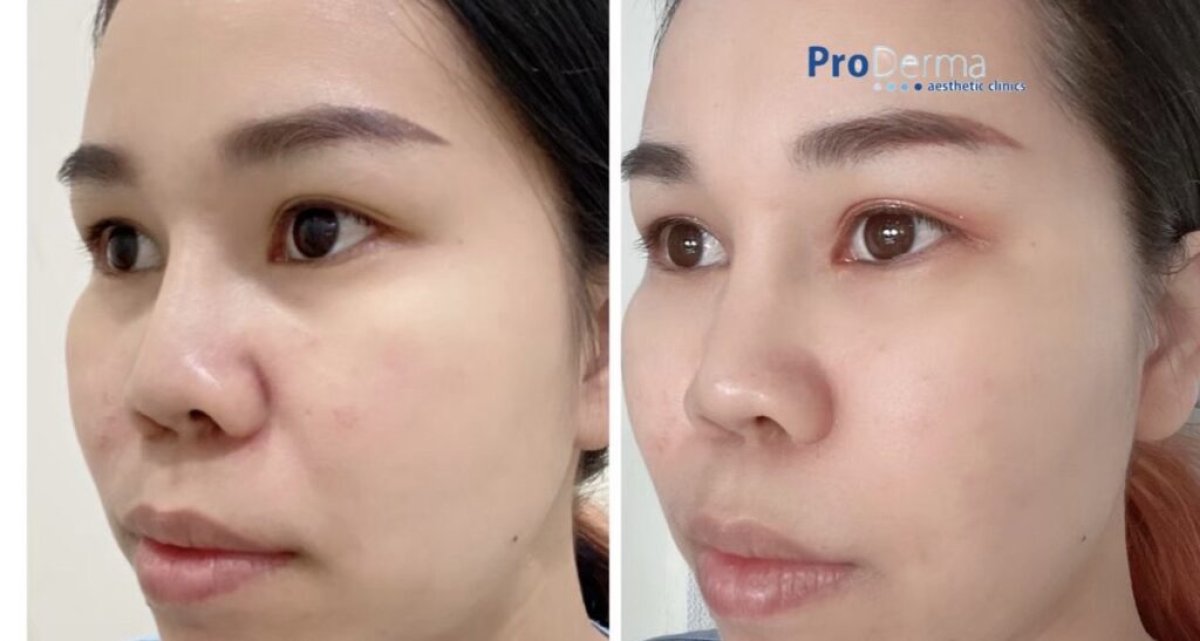 Antes y después de contorno de mandíbula en ProDerma: resultado de mayor definición facial