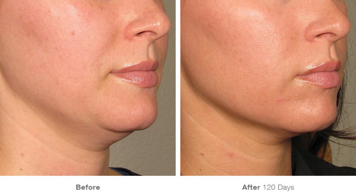 Before and after jawline contouring at ProDerma, improved chin and jaw definition result
