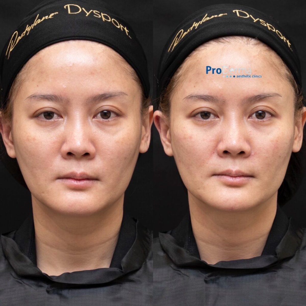 Before and after anti-wrinkle injectables at ProDerma, smoother facial skin result