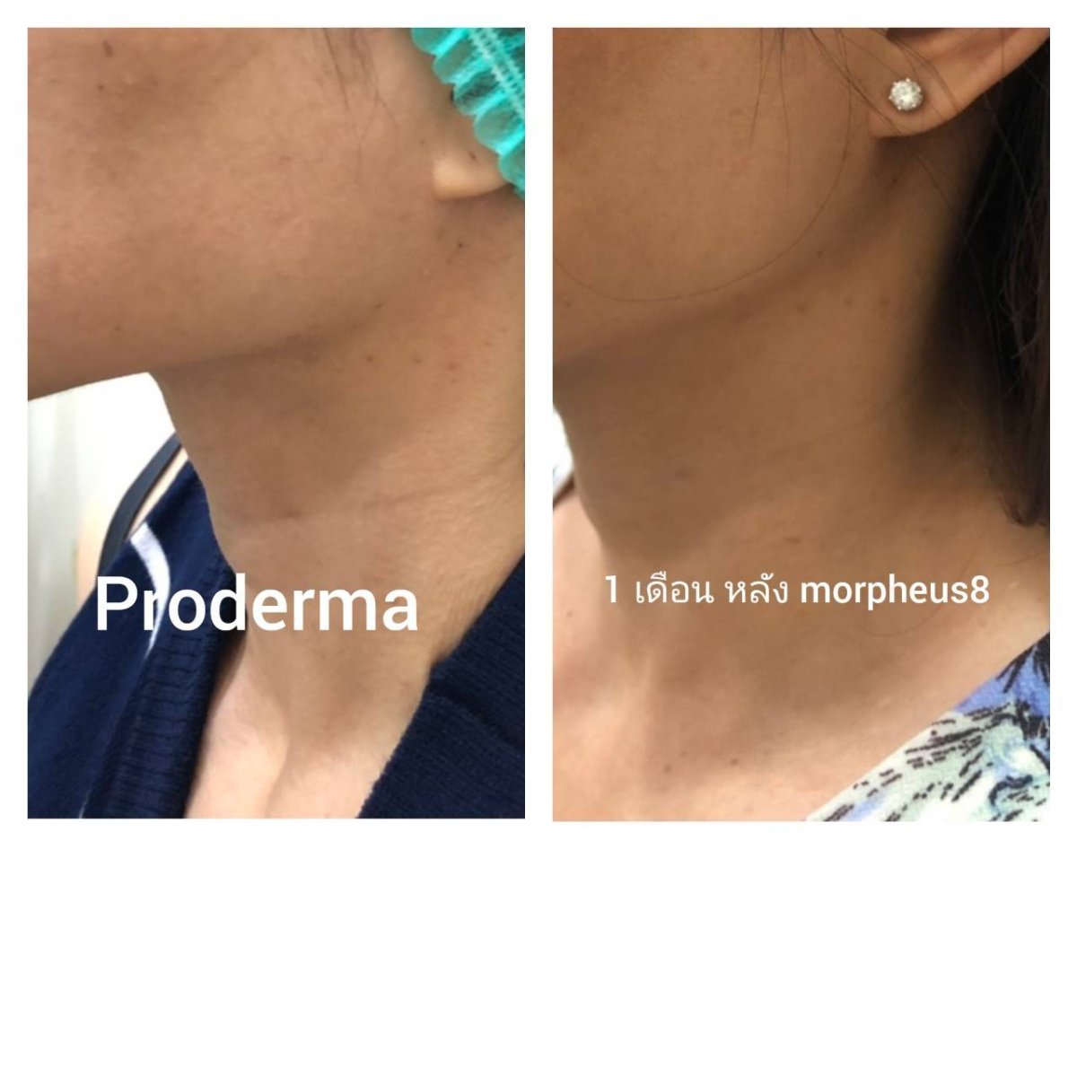 До і після Morpheus8 для обличчя в ProDerma – помітне підтягнення лінії підборіддя