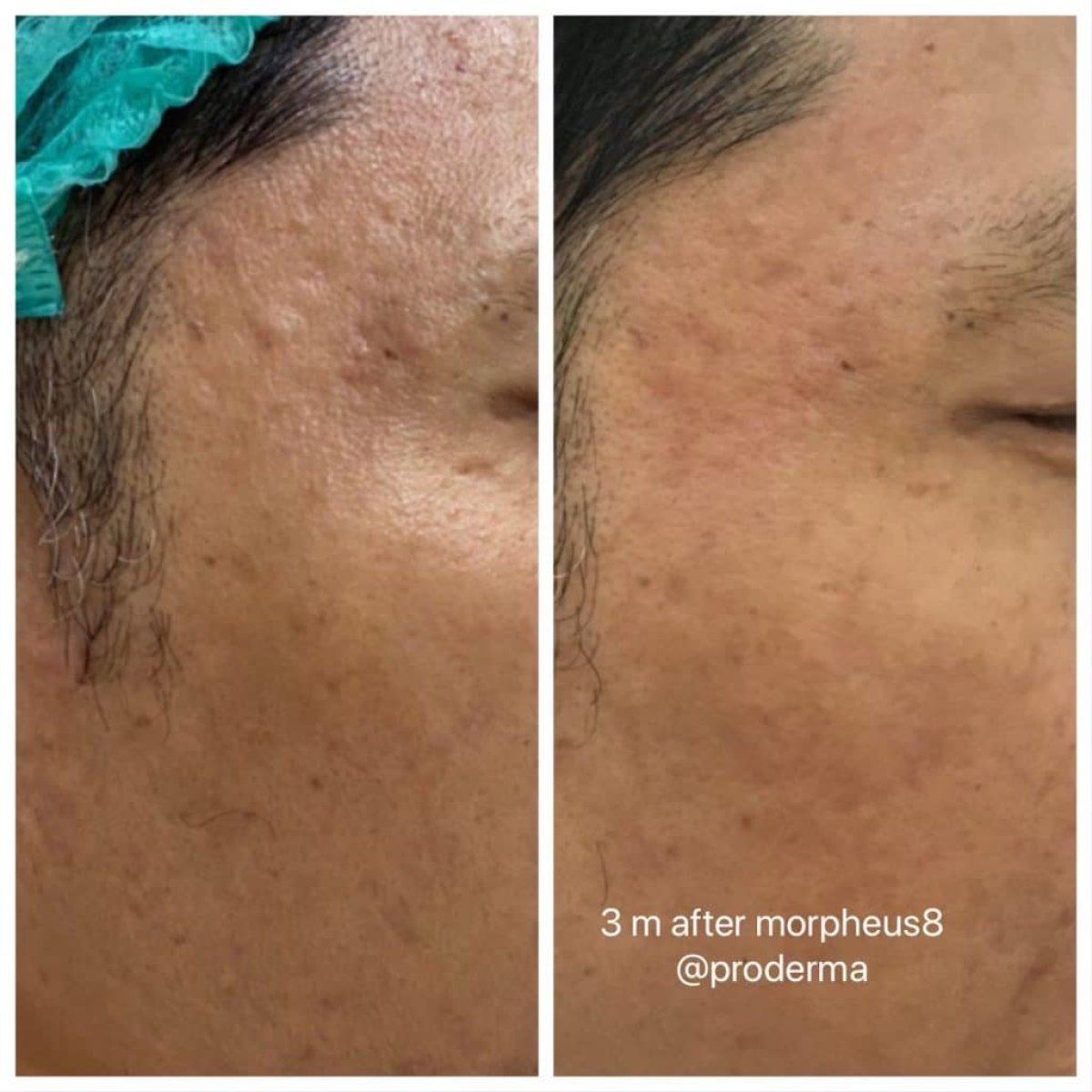 Resultado de Morpheus8 facial en ProDerma, 3 meses después – textura de piel más suave