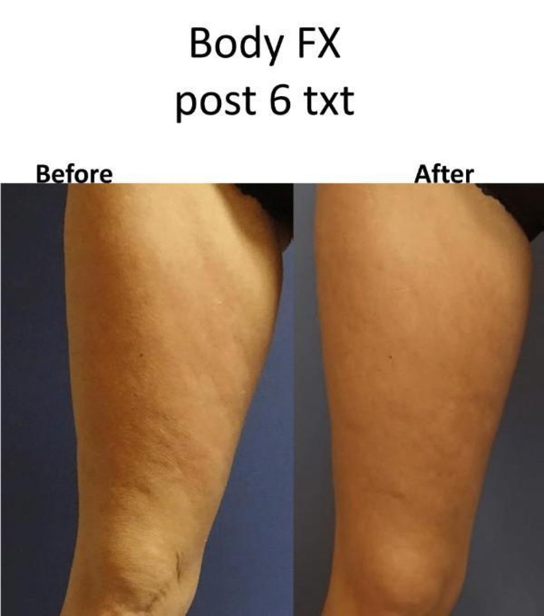 Antes y después de Body FX en ProDerma: resultados de muslo más suave