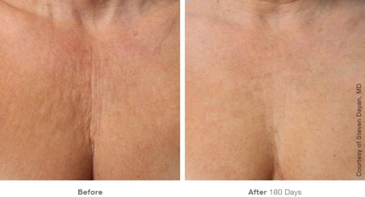 Résultats Morpheus 8 Body chez ProDerma : texture de la peau du buste améliorée