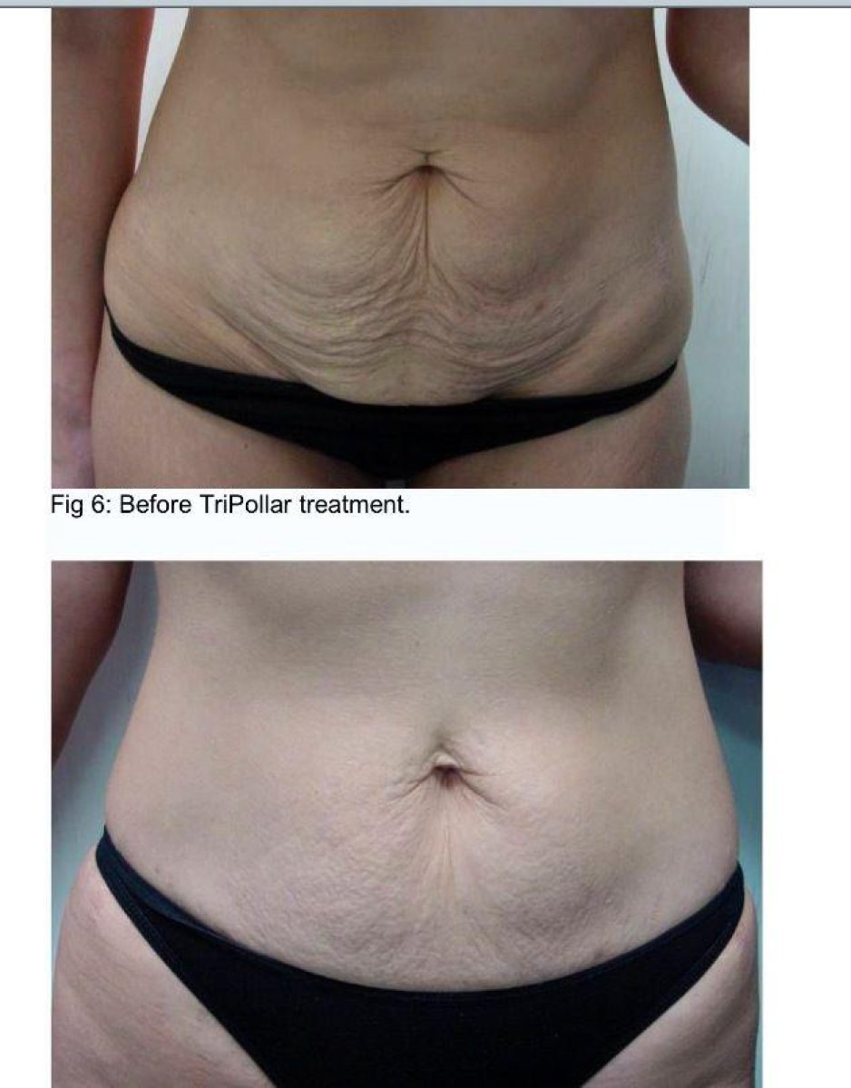 Avant-après Morpheus 8 Body chez ProDerma – résultat visible de raffermissement abdominal