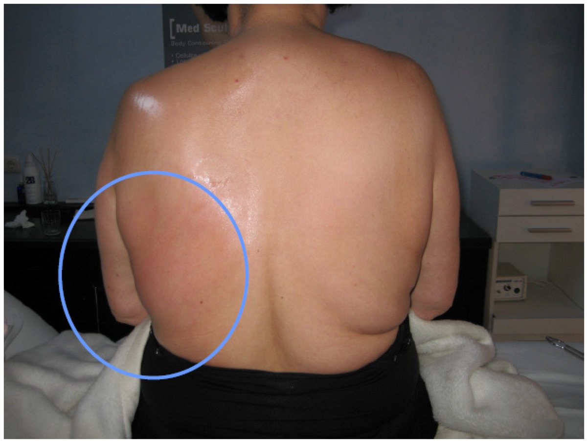 Resultado de Morpheus 8 Body en ProDerma: mejora de la textura de la piel en la espalda