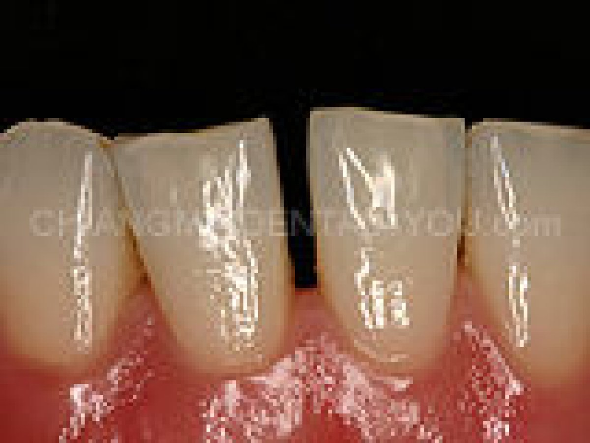 Résultat du détartrage dentaire à Dental 4 You Clinic – dents plus propres et saines