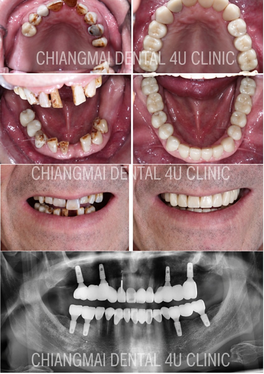Before and after dental implant with crown results at Dental 4 You Clinic, full mouth restoration