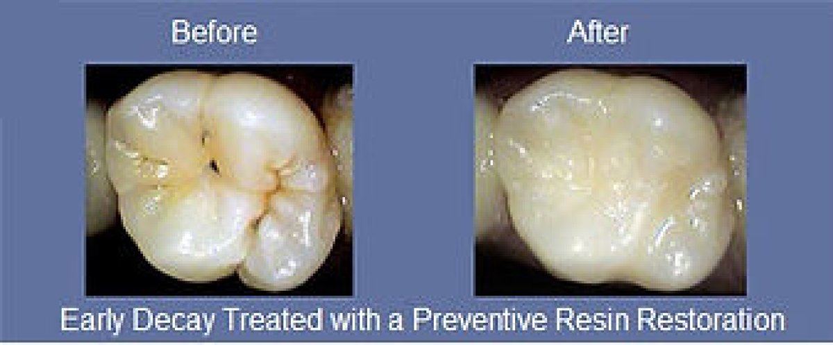 Resultados de empaste compuesto antes y después para caries en Dental 4 You Clinic