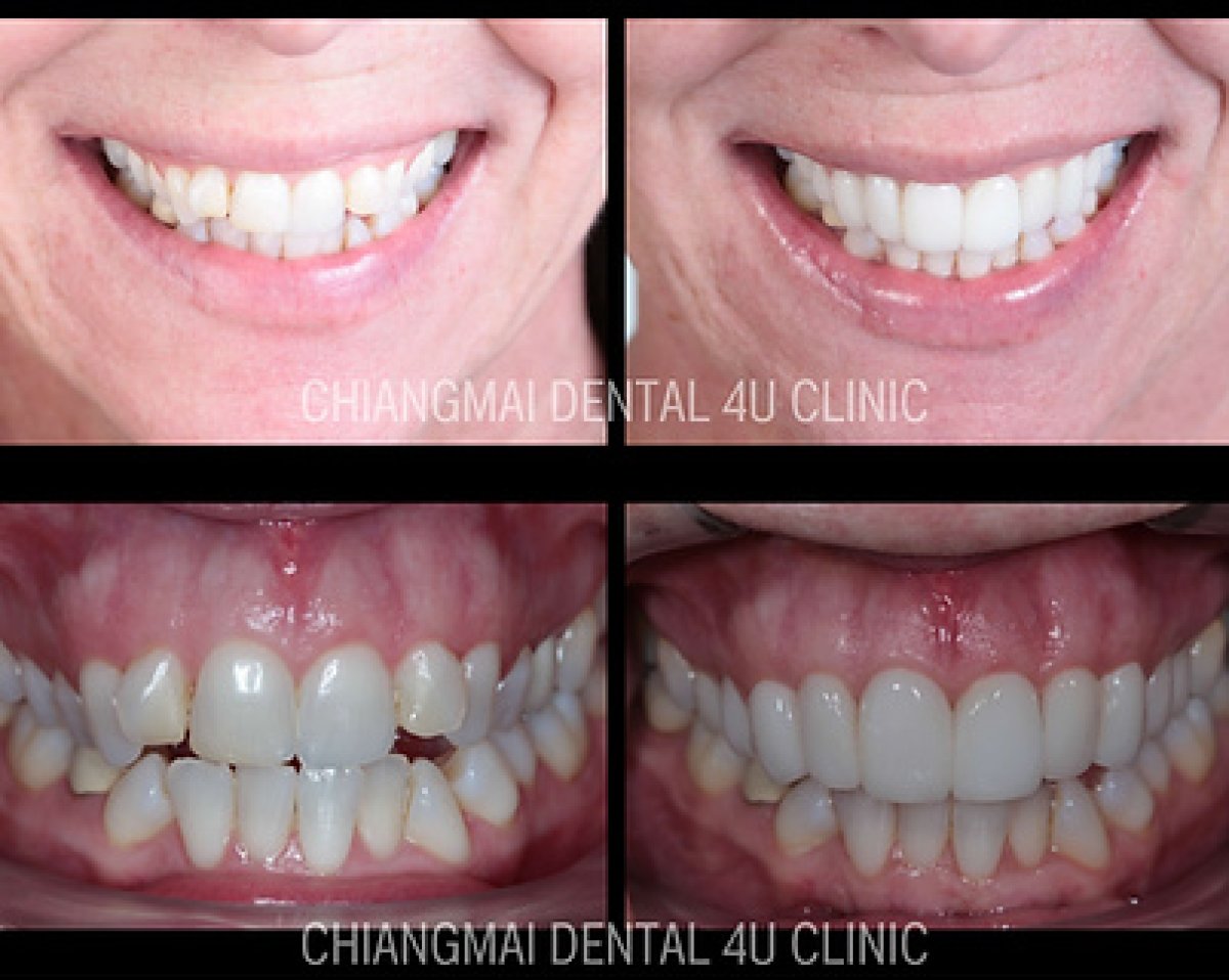 Résultats avant/après blanchiment dentaire à Dental 4 You Clinic, sourire éclatant