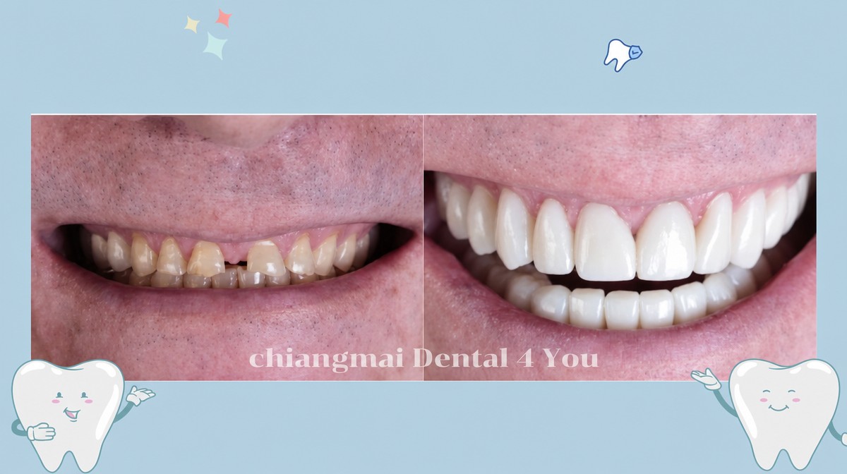 Résultats avant et après blanchiment dentaire à Dental 4 You Clinic, sourire éclatant