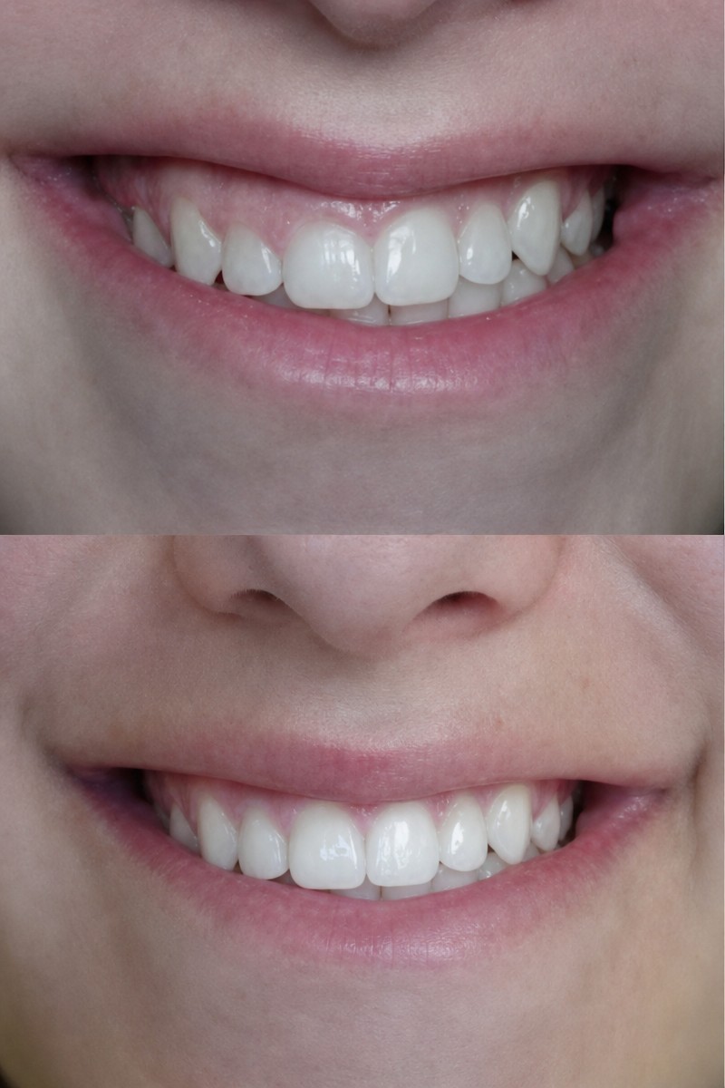 Resultados de blanqueamiento dental antes y después en Dental 4 You Clinic – sonrisa más blanca