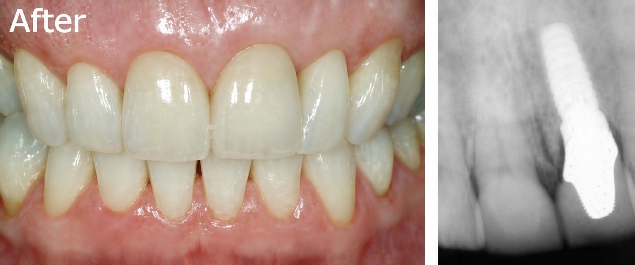 Resultado de implante dental en Dental 4 You Clinic: diente restaurado y radiografía