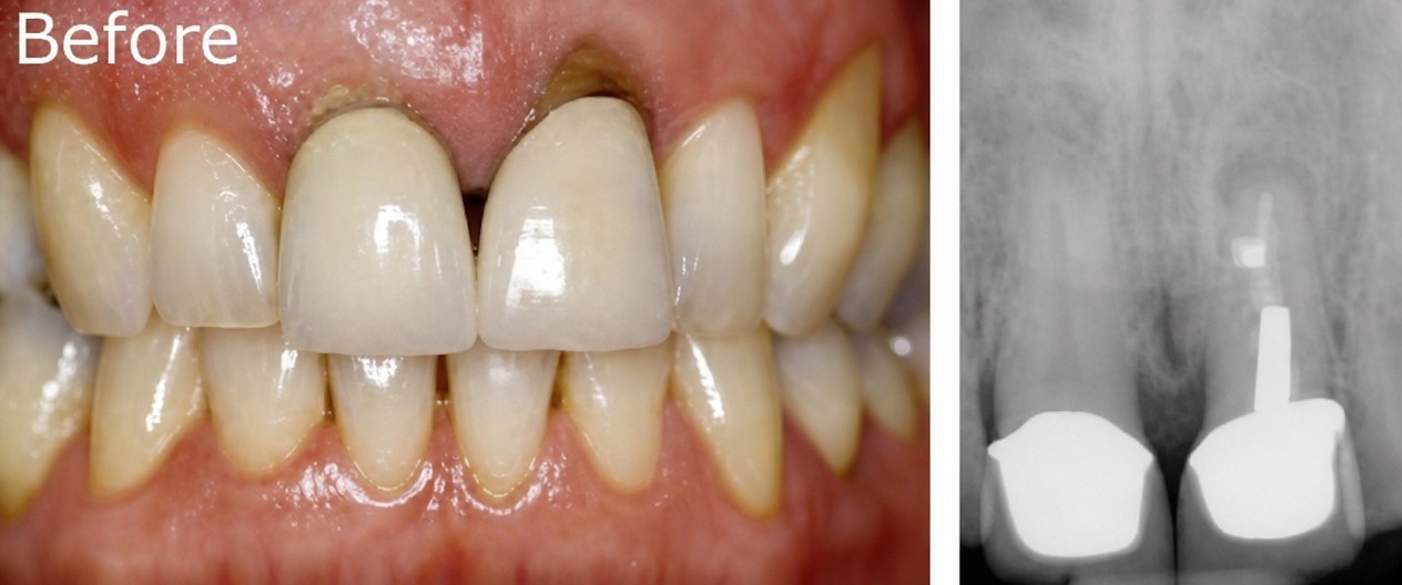 До установки зубных коронок в Dental 4 You Clinic, видны проблемы и рентген результат