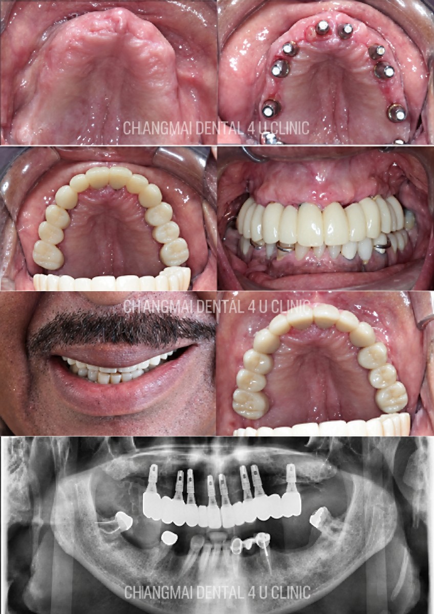 Full-arch implant-fixed zirconia dentures result at Dental 4 You Clinic, smile restoration