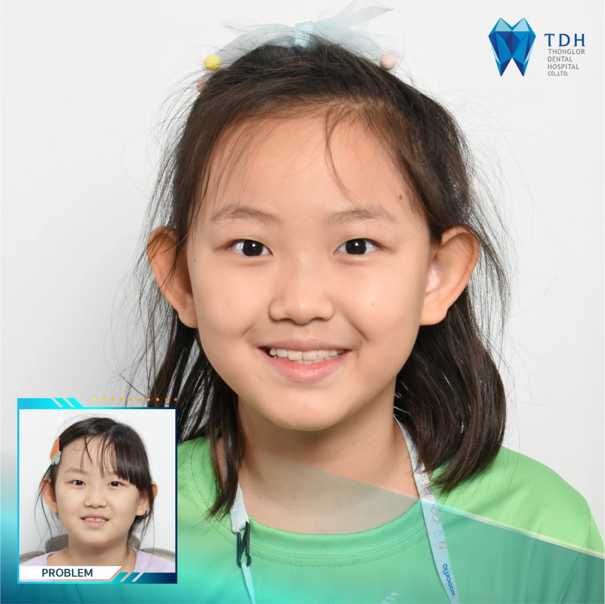 Resultados de cirugía ortognática antes y después en Thonglor Dental Hospital, mejor alineación mandibular