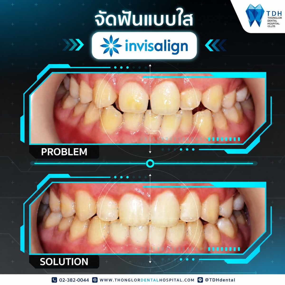 نتائج قبل وبعد تقويم Invisalign في Thonglor Dental Hospital – تقويم الأسنان