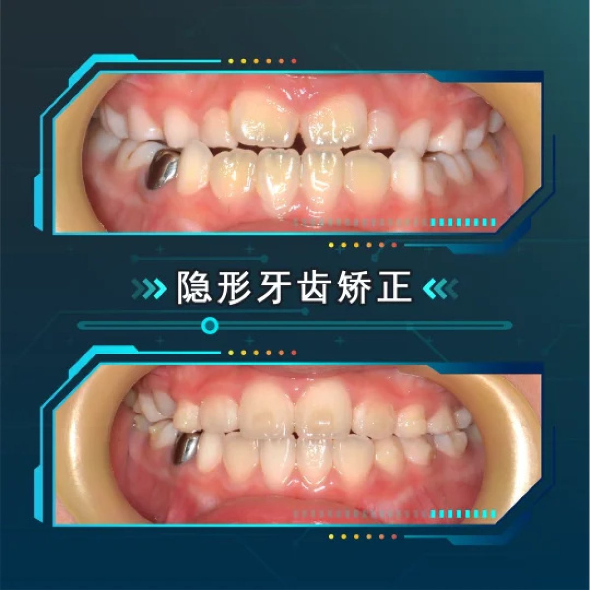 نتائج قبل وبعد تقويم Invisalign في Thonglor Dental Hospital، تحسين انتظام الأسنان