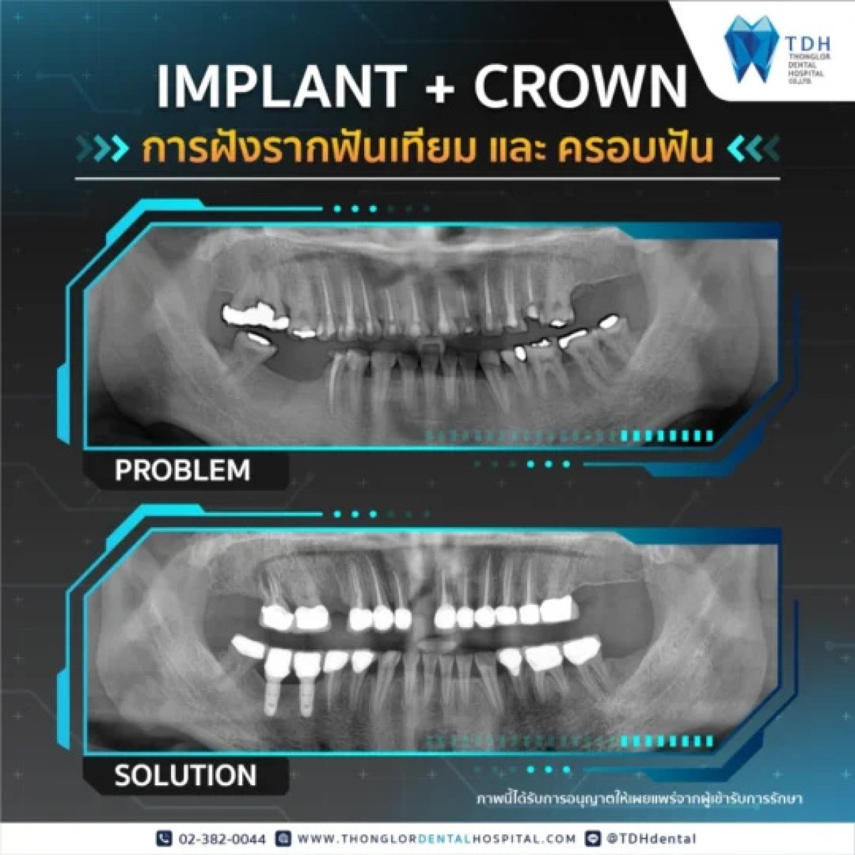 Before and after dental implant with crown results at Thonglor Dental Hospital, improved smile