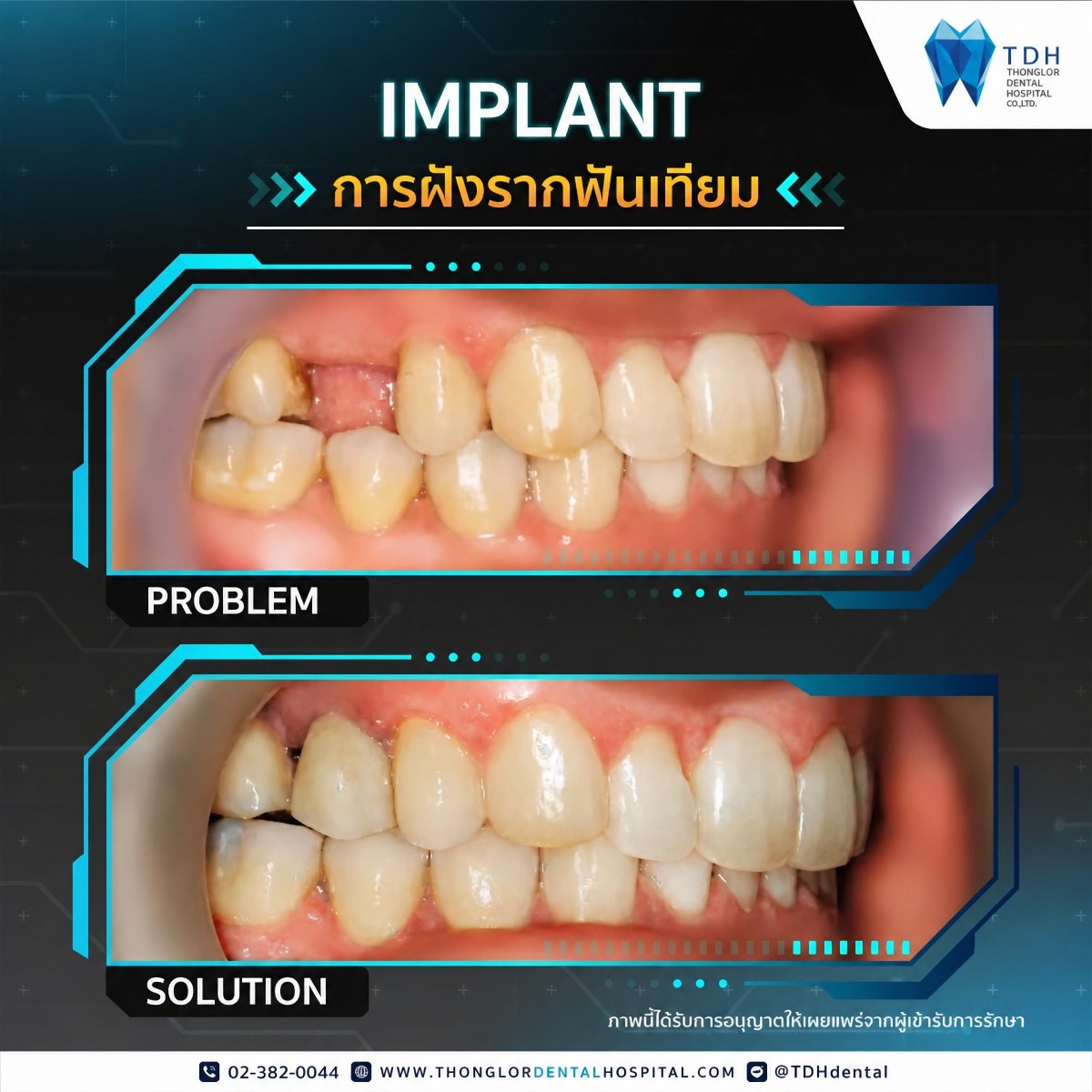 Resultados de implantes dentales antes y después en Thonglor Dental Hospital, sonrisa restaurada