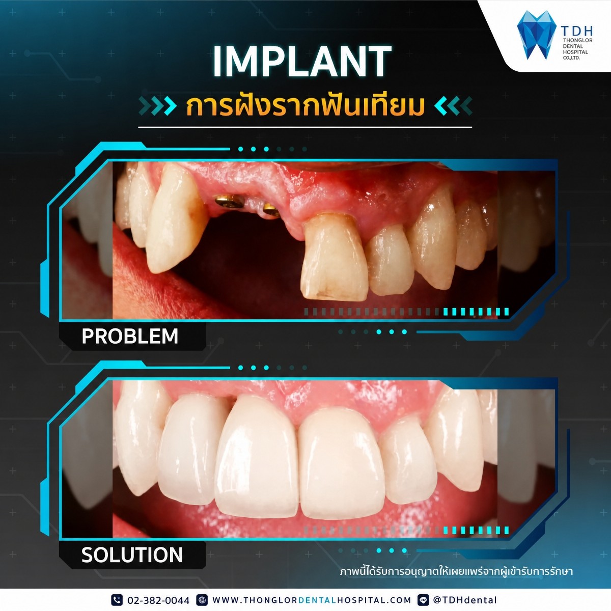Resultados antes y después de implantes dentales en Thonglor Dental Hospital – sonrisa restaurada