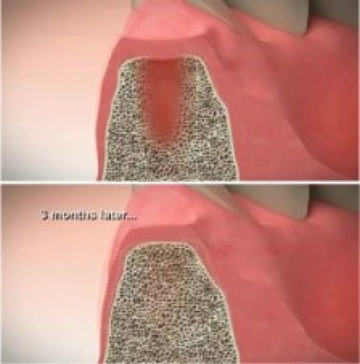 Результаты костной пластики до и после в Thonglor Dental Hospital, восстановление челюсти