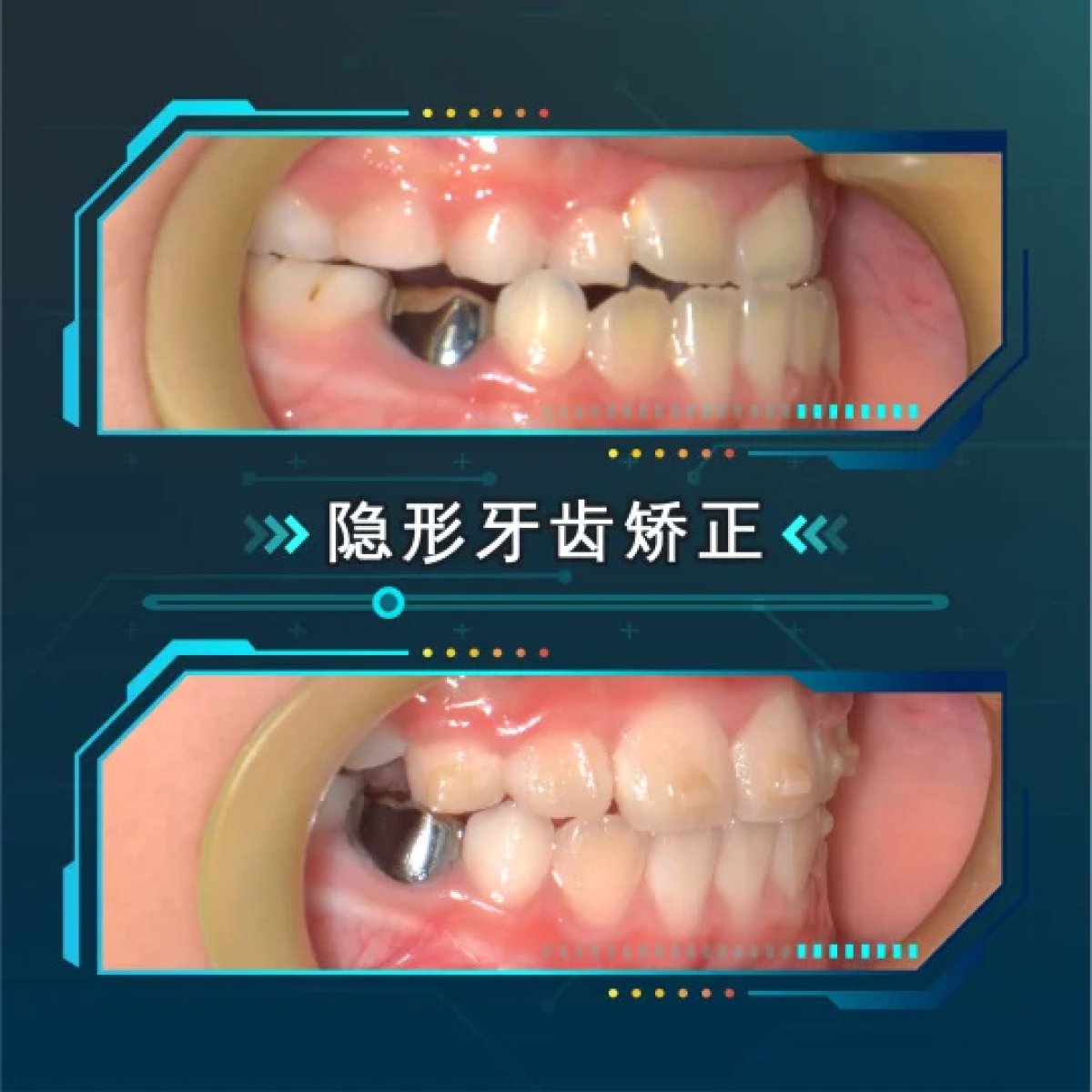 Before and after clear aligners results at Thonglor Dental Hospital, improved teeth alignment