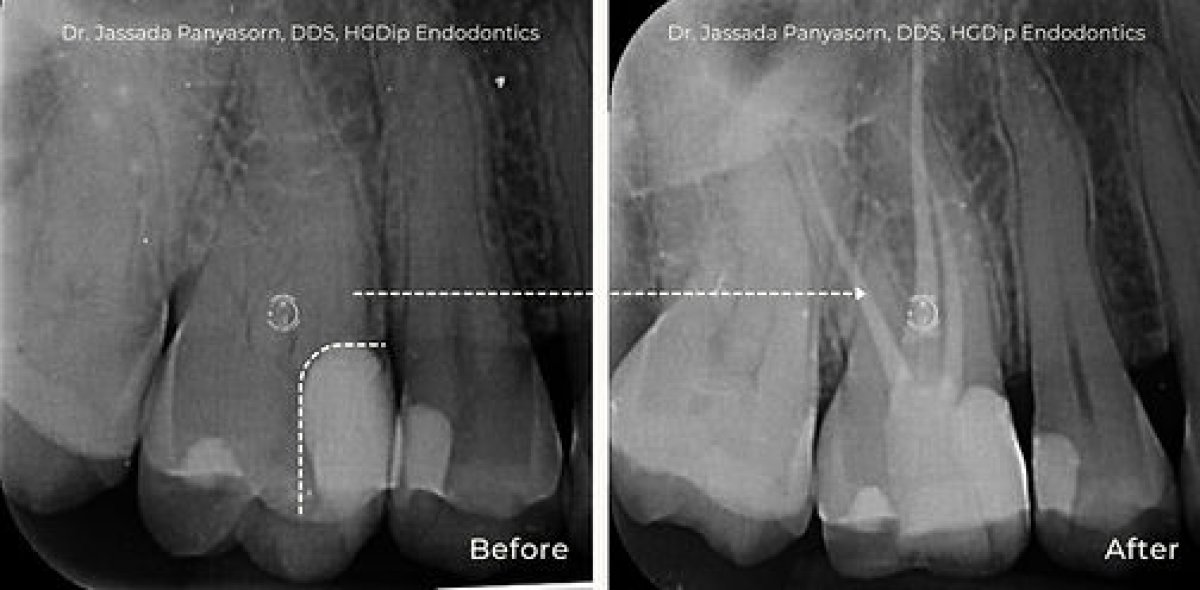 Resultado antes y después de tratamiento de conducto en Empress Dental, mejora visible