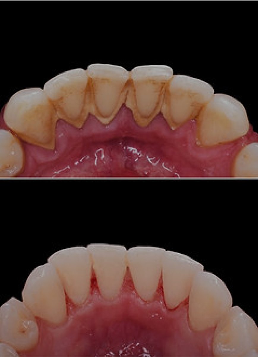 Resultados de limpieza dental (raspado) antes y después en Empress Dental – eliminación de placa