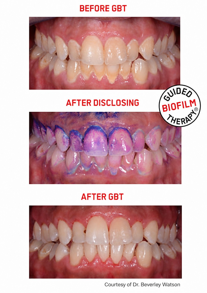 Resultados antes y después de la limpieza dental (scaling) en Empress Dental con Guided Biofilm Therapy