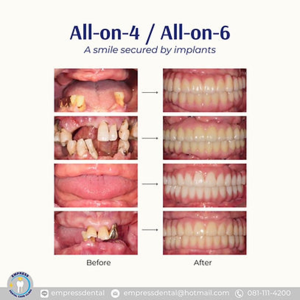 Resultados antes y después de implantes All-on-4 en Empress Dental – restauración total de la sonrisa