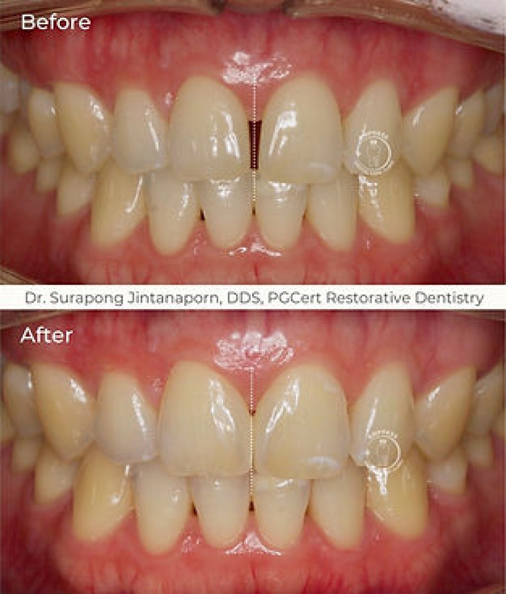 Resultados antes y después de carillas de porcelana en Empress Dental – alineación dental mejorada