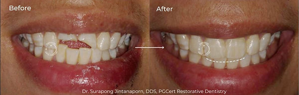Resultados de restauración dental antes y después en Empress Dental – sonrisa mejorada