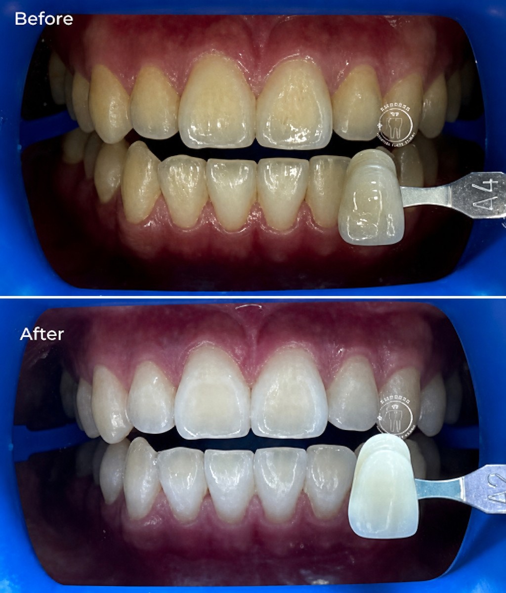 Результаты отбеливания зубов до и после в Empress Dental – заметно более белые зубы